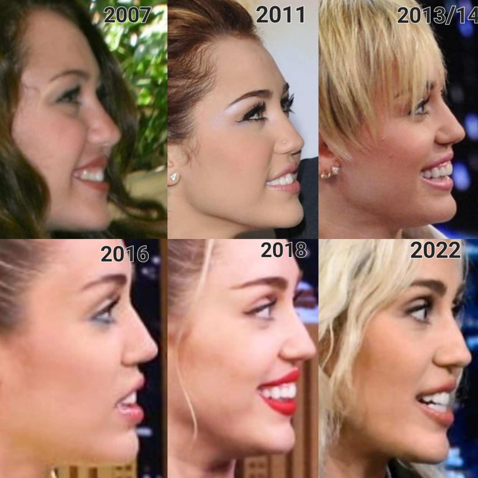 Miley Cyrus Plastic Surgery A Comprehensive Look