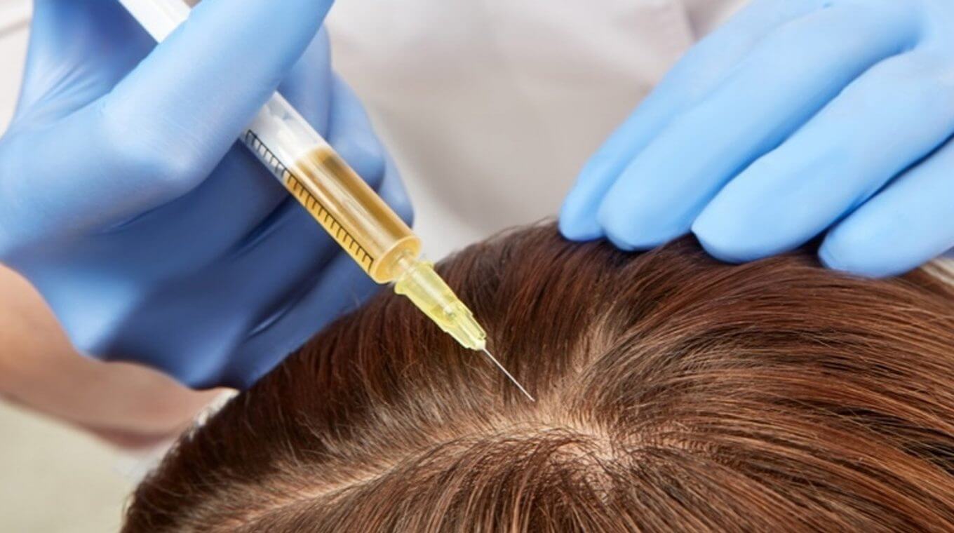 Top 48 image treatment for hair loss Thptnganamst.edu.vn