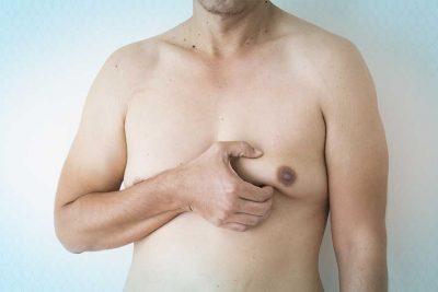 Gynecomastia Surgery The Only Treatment for Male Breast