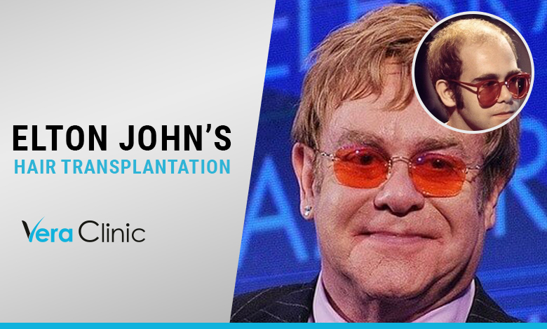 Elton John's Hair Transplantation - Vera Clinic