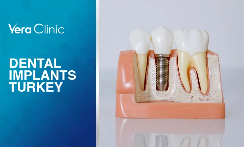 Dental Implants Turkey How It Works