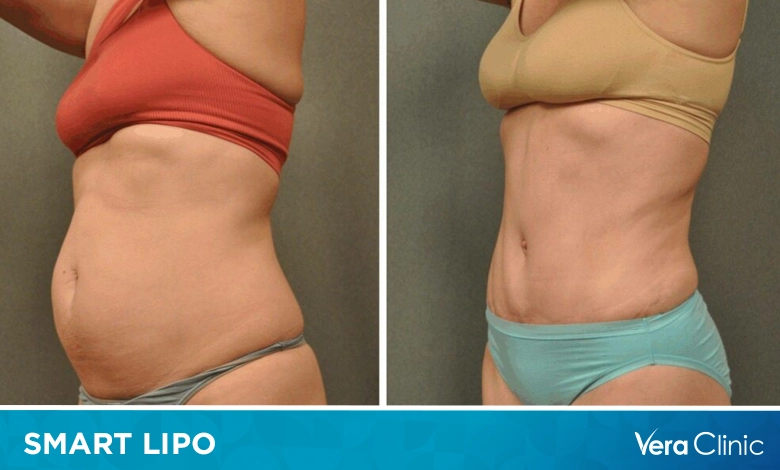 Arm Lipo Healing Essentials: Using Compression Garments for Optimal Results