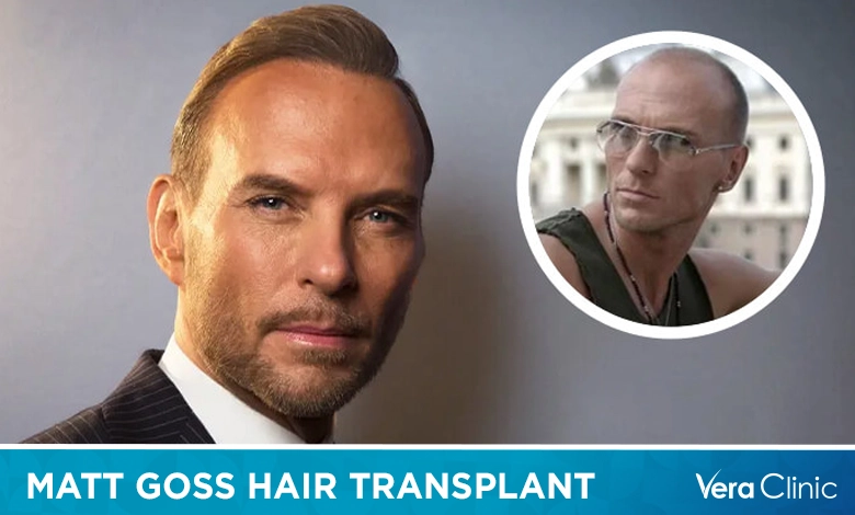 Matt Goss Hair Transplant The Mystery Behind His Journey