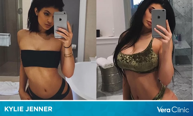 Kylie Jenner BBL: Is It Real Or Fake?