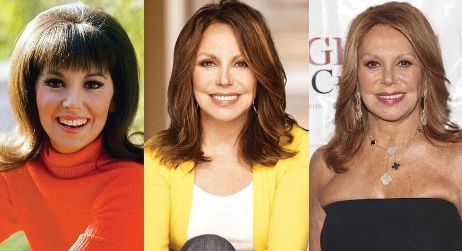 Marlo Thomas Plastic Surgery: Separating Fact from Fiction