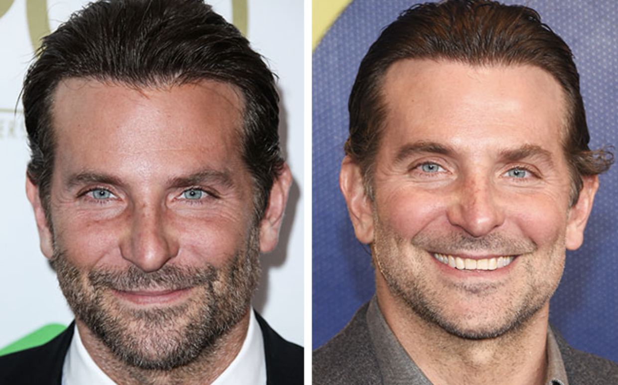 Bradley Cooper Teeth Before and After: Dental Transformation