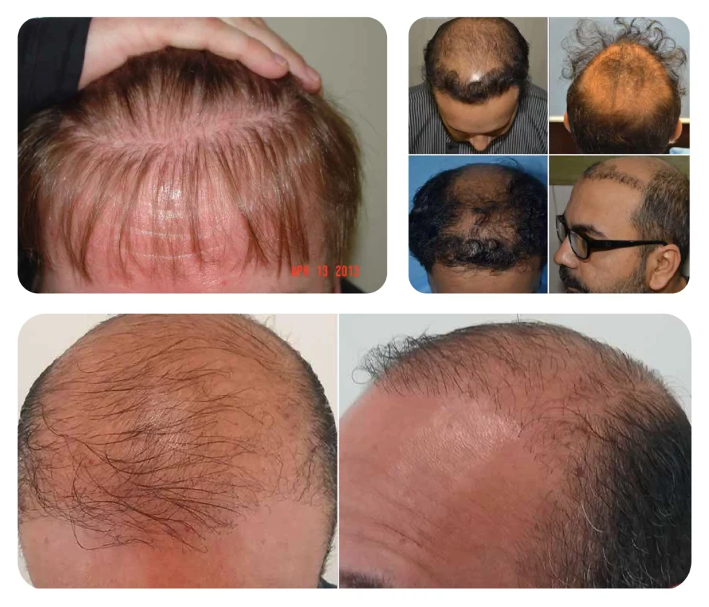 Hair Transplant In Turkey 2024 Vera Clinic