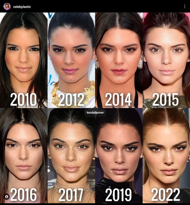 Kendall Jenner Plastic Surgery Journey Exploring The Rumors And Realities 