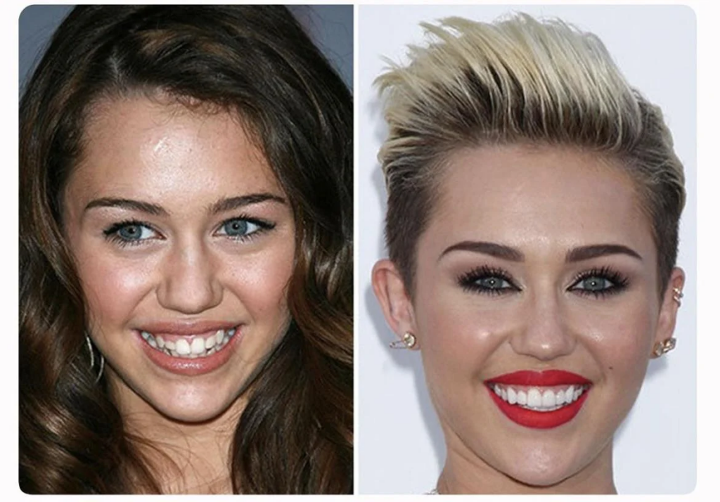 Miley Cyrus Plastic Surgery: A Comprehensive Look