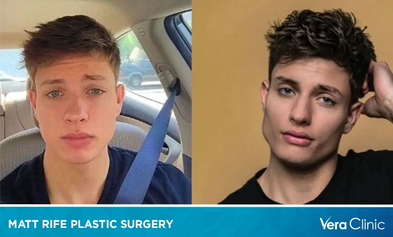 Matt Rife Plastic Surgery: A Deep Dive into Rumors