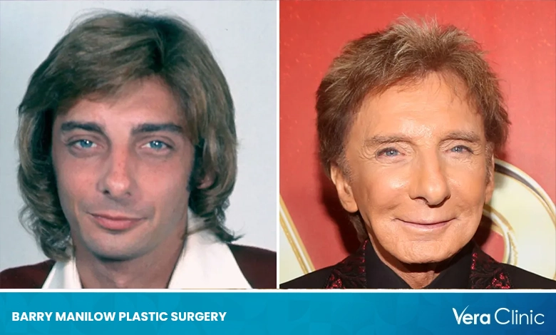 Barry Manilow Plastic Surgery From Rumors to Reality