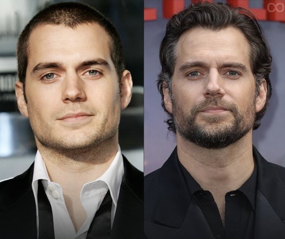 Henry Cavill Hairline: A Before and After Analysis