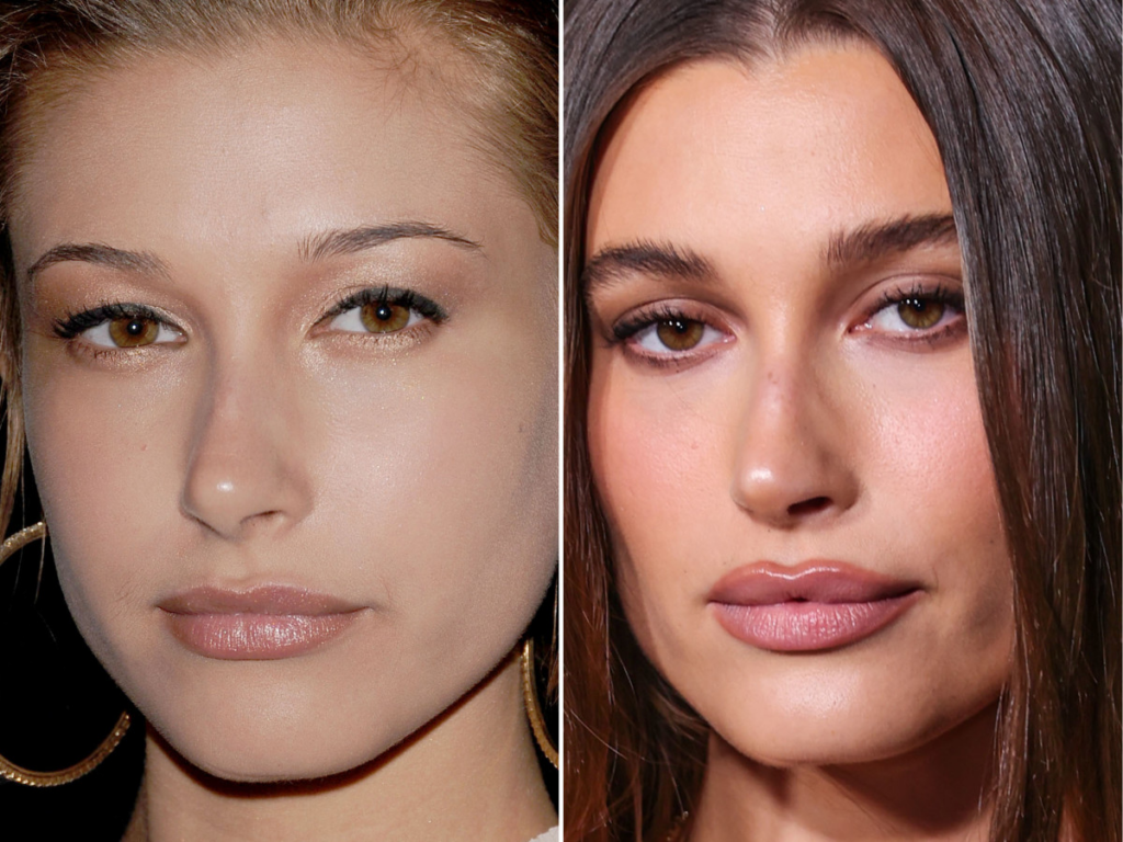 Hailey Bieber Plastic Surgery: The Evolution of Beauty