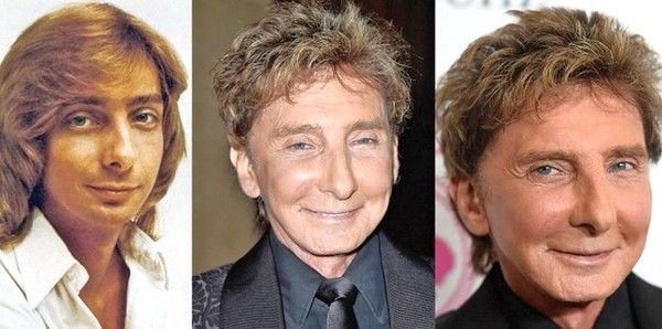 Barry Manilow Plastic Surgery From Rumors to Reality